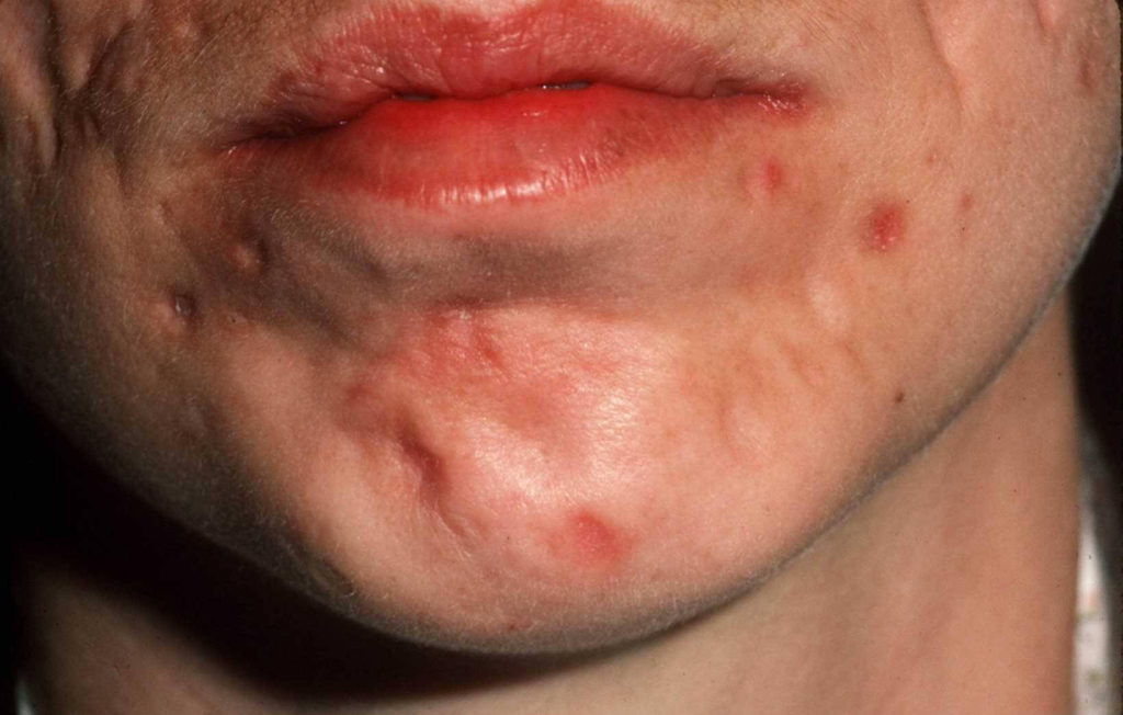 Acne-excoriee-kin-wondjes-en-littekens-1024x652
