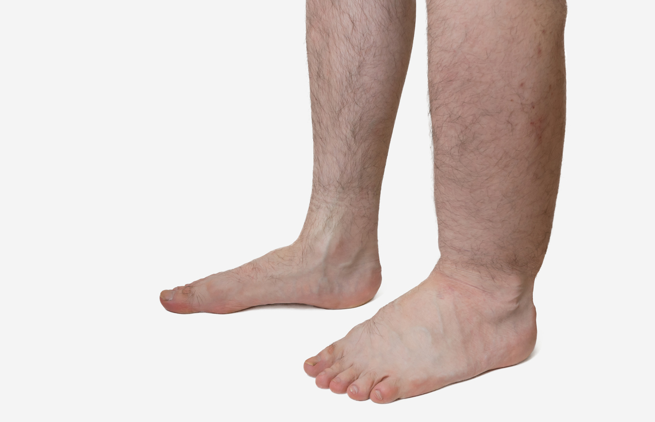 Leg of diseased patient who suffers from Edema.