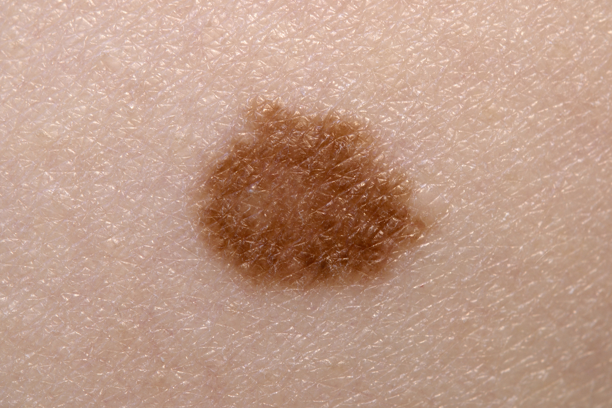 Skin mole